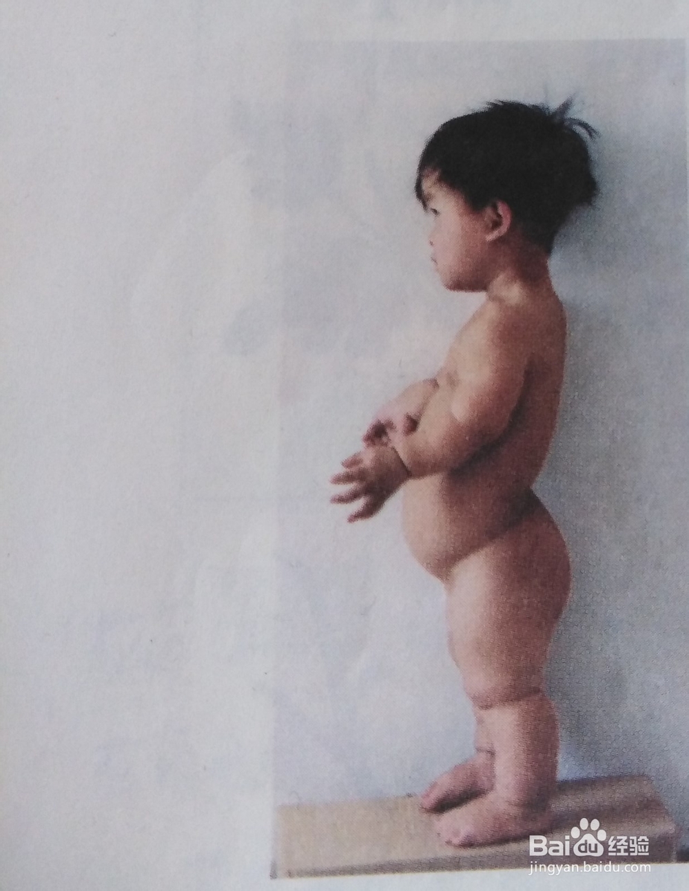 救人一命胜造七级浮屠——您了解苯丙酮尿症吗？