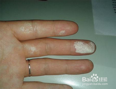 双氧水把手烧白了怎么办