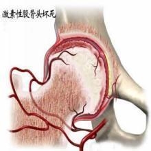 股骨头坏死该如何去防治