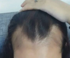 头发脱落严重怎么办