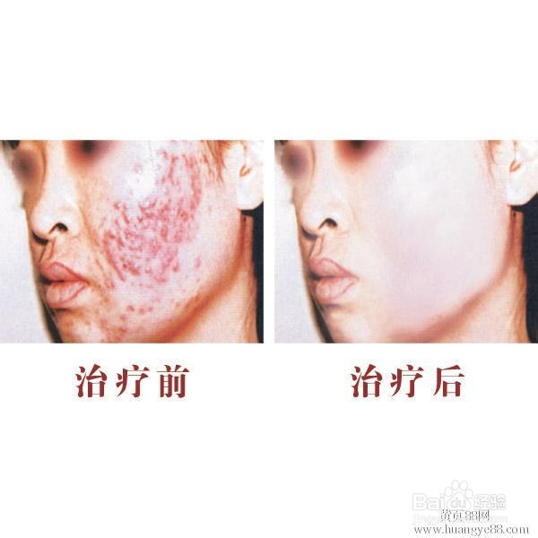 欣疤克祛疤真的有用吗?