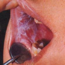 治扁平苔藓的方法