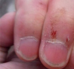 指甲周围长倒刺，一招就能轻松解决