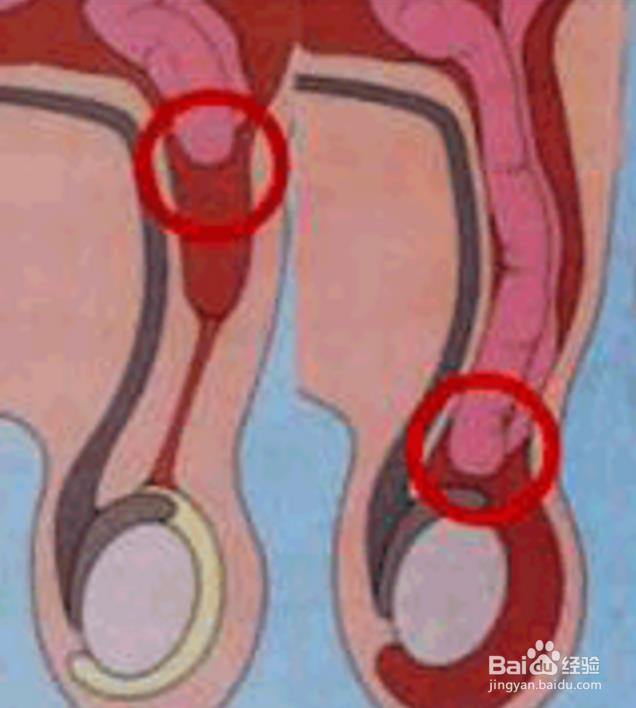腹股沟区解剖的复习