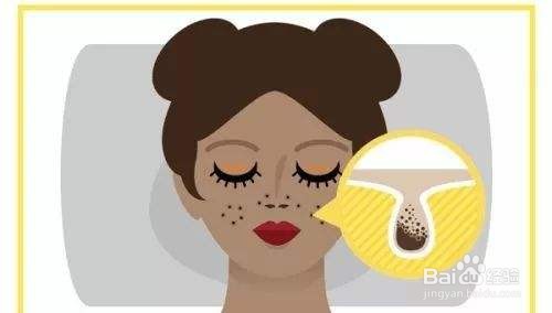 为什么会长黑头？黑头如何祛除？