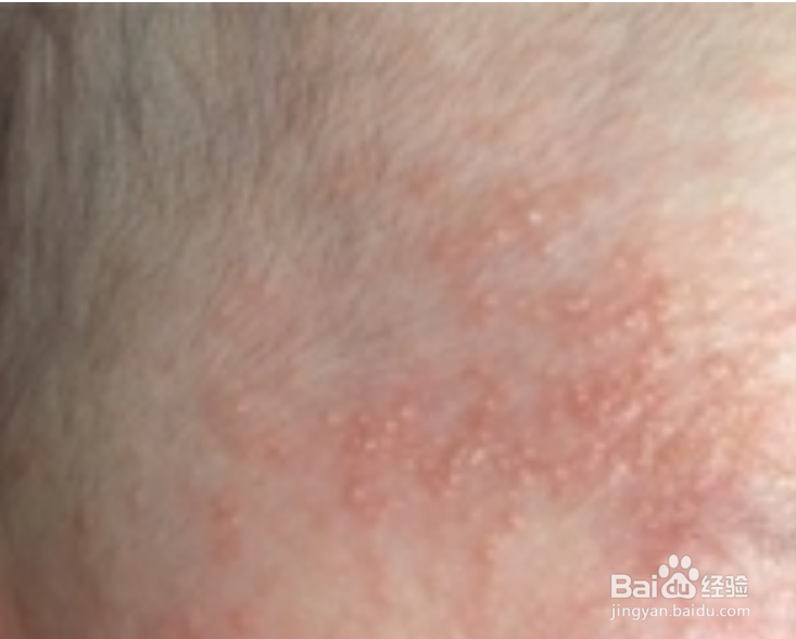 十个月宝宝的耳朵湿疹晚上哭闹要怎么办