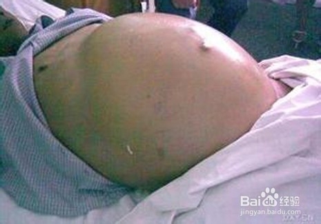 结核性腹膜炎在临床上的常见表现有哪些？