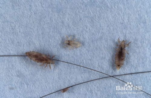 去虱子卵最简单的方法 小孩有头虱子怎么去除 百度经验