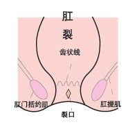 大便出血的原因——六大肛肠疾病