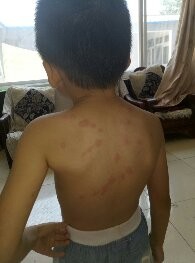 孩子被蚊子叮了好多包包，怎么办