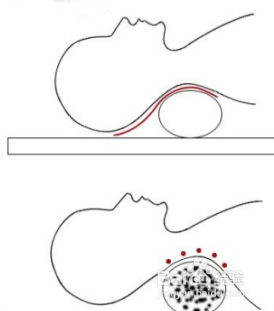 如何缓解我们常见的颈椎病