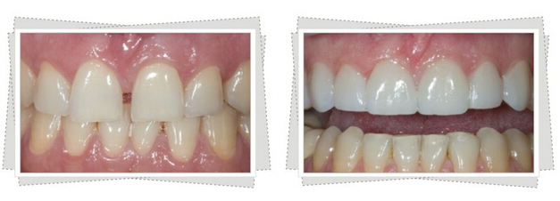 牙齿贴面的优势