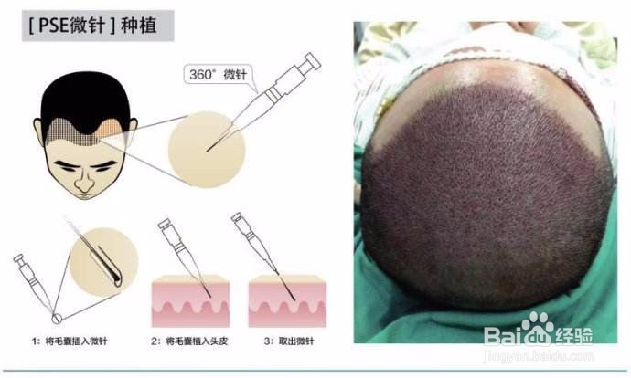鬓角种植前怎么做不会留下疤痕