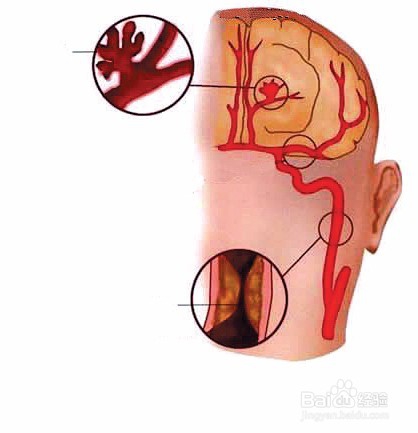 怎样预防血管堵塞,心血管堵塞有哪些症状