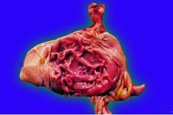 糜烂性胃炎有什么危害?