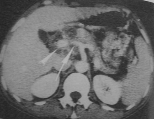 胰腺癌的表现症状有哪些，如何预防胰腺癌