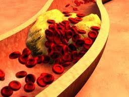 动脉硬化发病原因