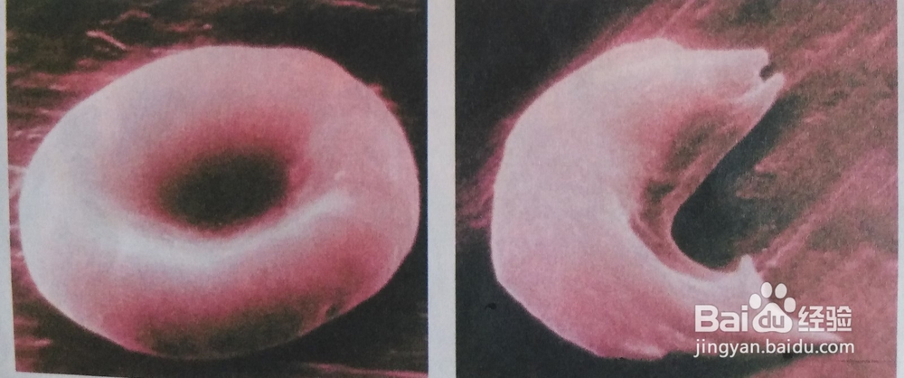 救人一命胜造七级浮屠——您了解苯丙酮尿症吗？