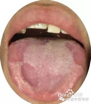 怎样通过舌头判断疾病