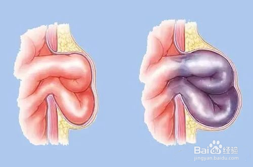 小儿疝气怎么治疗最安全