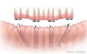 种牙后该如何维护？