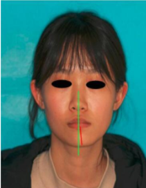 如何分辨髁突肥大