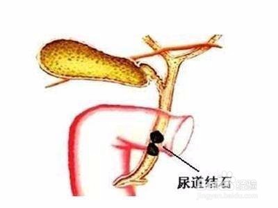 尿道结石疼痛怎么办?