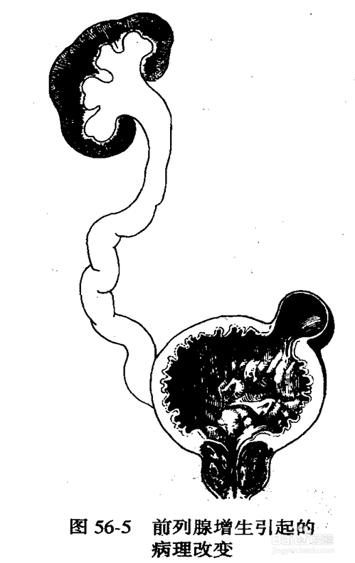 良性前列腺增生?