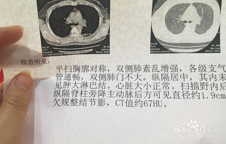 哪些人需要定期做CT检查？