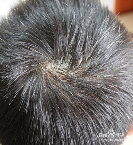 为何年纪轻轻就白发？赶紧看看什么原因吧！