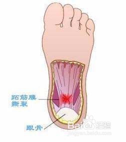 如何避免筋膜炎的发生