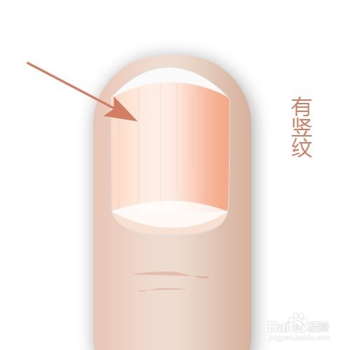 通过指甲看身体状况