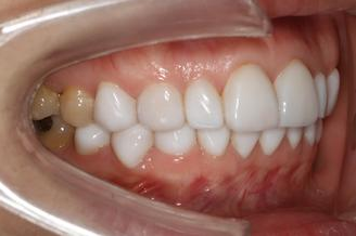 牙齿贴面的优势