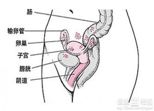 女性慢性盆腔炎的征兆及预防