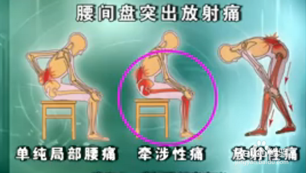 如何维护我们的腰椎