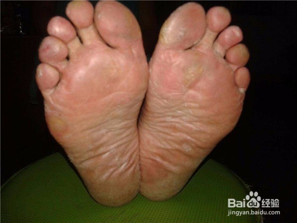 脚后跟皮肤开裂？5个方法解决你的问题! 真有用