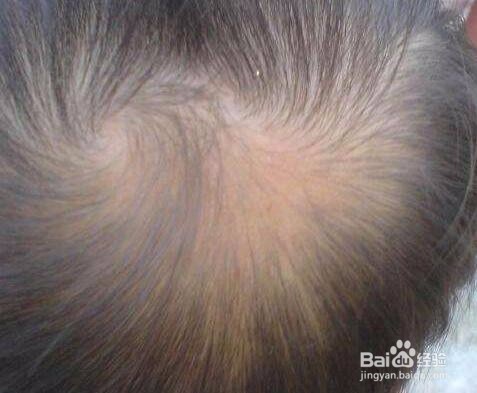 掉头发很厉害？学会这些从此告别掉发！