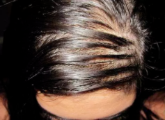 头发脱落严重怎么办