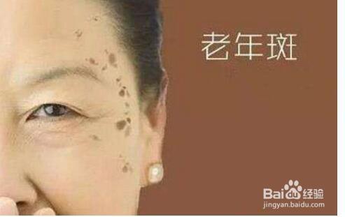怎样去掉老年斑