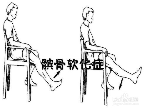 髌骨软化症的症状是什么