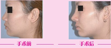 如果做韩式隆鼻用什么材料最好