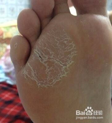 糖尿病足的早期症状 如何预防糖尿病足 百度经验