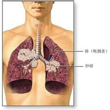 肺癌的前期表现