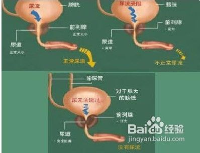 前列腺肥大吃什麼藥