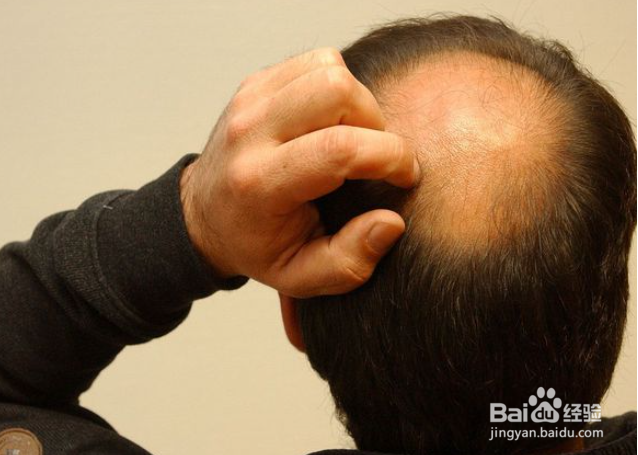 男士头发掉得很严重,应该怎么办