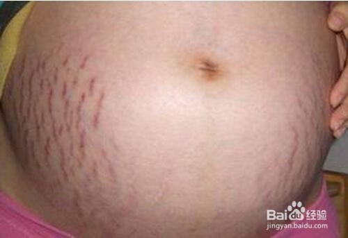 如何去除妊娠纹 我的个人经历分享