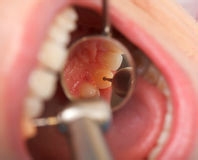 补牙虫牙全过程是怎么样的？