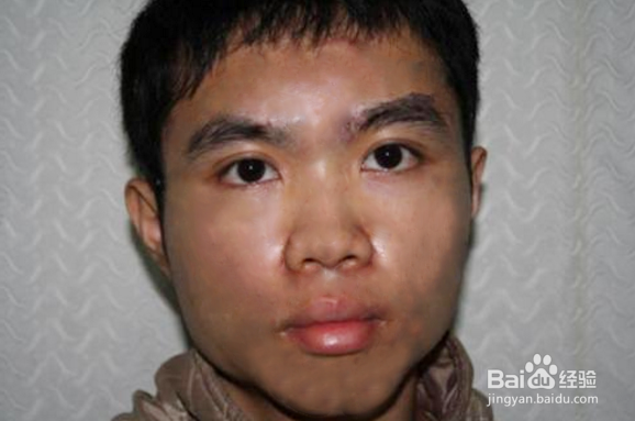 祛痘印最快的方法