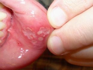 口腔溃疡的主要治疗方法