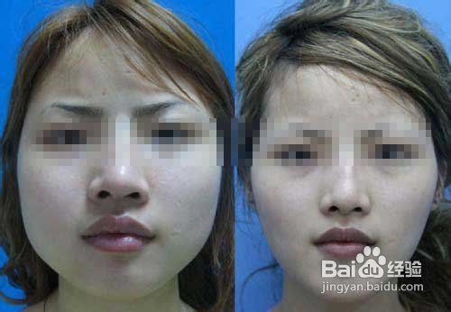 先天不足后天补救隆鼻成女性最爱 百度经验